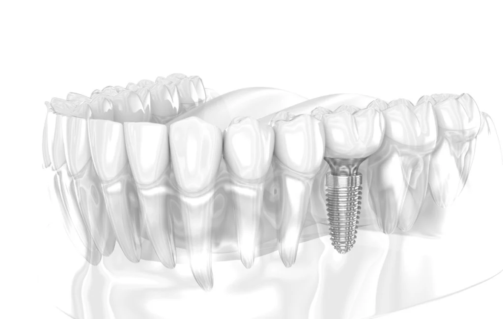 implant dentaire planification numerique exocad Implantologie label-dent