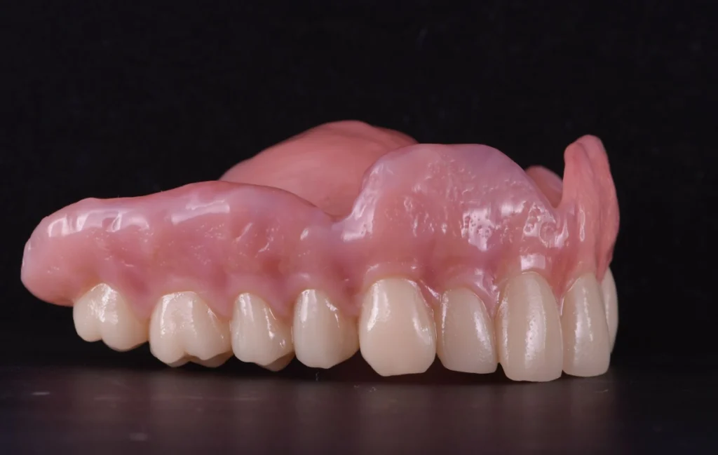 prothese conjointe laboratoire dentaire expert Prothèse adjointe numérique label-dent