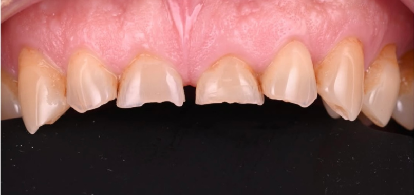 cas dentisterie esthetique solutions prothetiques avancees Nos réalisations label-dent