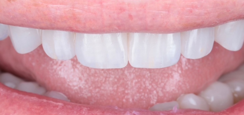 dentisterie esthetique laboratoire dentaire expert Nos réalisations label-dent