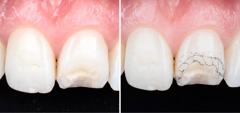 titane prothese dentaire haute resistance Nos réalisations label-dent