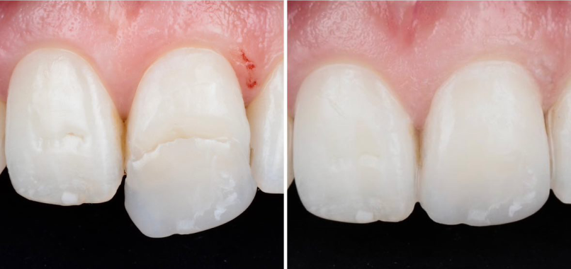 zicorne prothese esthetique precision Nos réalisations label-dent