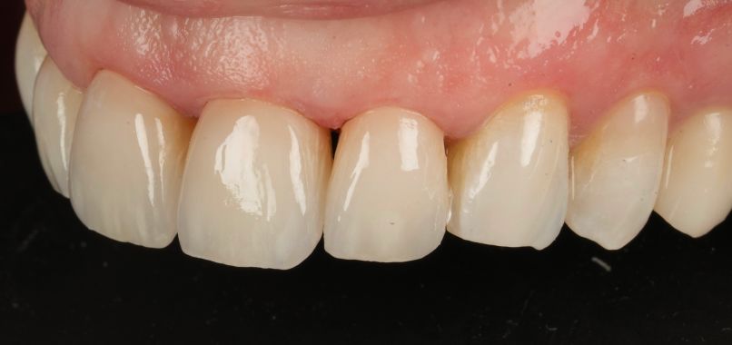 prothese dentaire adaptation morphologique parfaite Nos réalisations label-dent