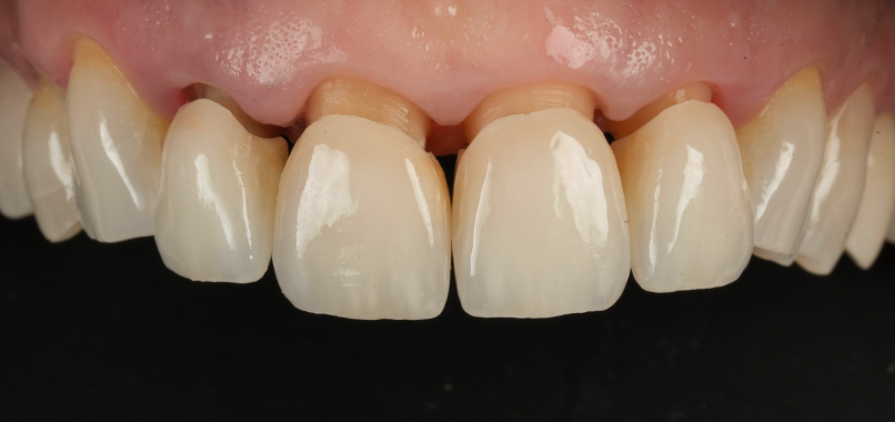 prothese dentaire restauration sur mesure Nos réalisations label-dent